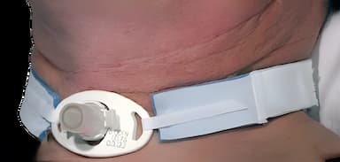 Tracheostomy Tube Holder AirLife® Neonatal / Pediatric
